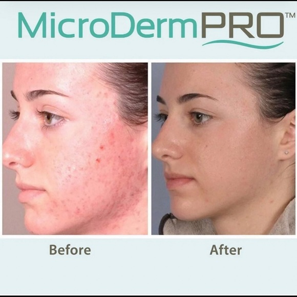 Buy 1 Get 1 FREE! Exfoliation & Microdermabrasion MicroDerm360 PRO NIB - Picture 1 of 10